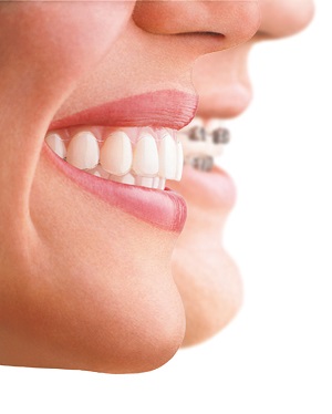 clear braces with Invisalign