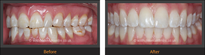 orthodontics before and after left