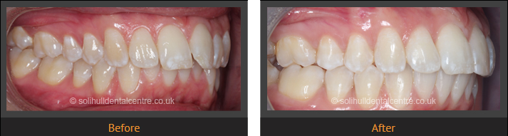 orthodontics before and after, right