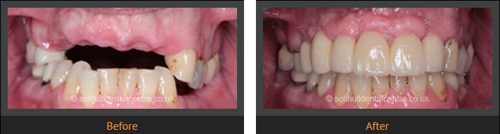 dental implants to replace the top front teeth, before and after