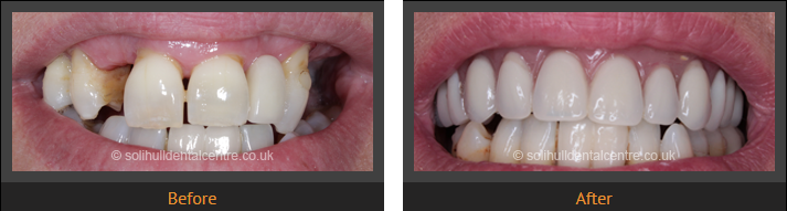 replacing the front teeth with dental implants