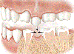 Leaving the gap after tooth has been lost