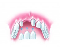 Dental bridges to replace missing teeth