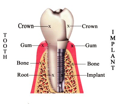 Dental implant Compared to tooth root