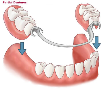 Partial denture showing clasps