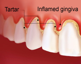 gingivitis