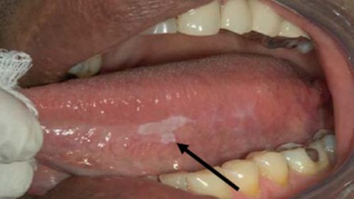 Mouth cancer on the tongue