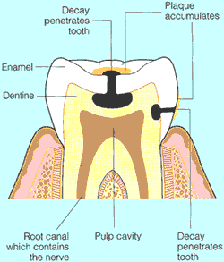 Tooth decay