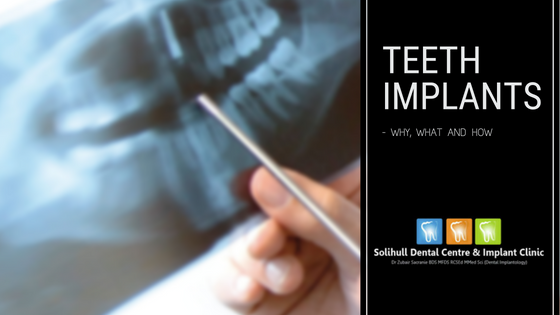 Teeth implants-what, why and how