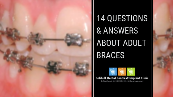 Questions and answers about adult braces