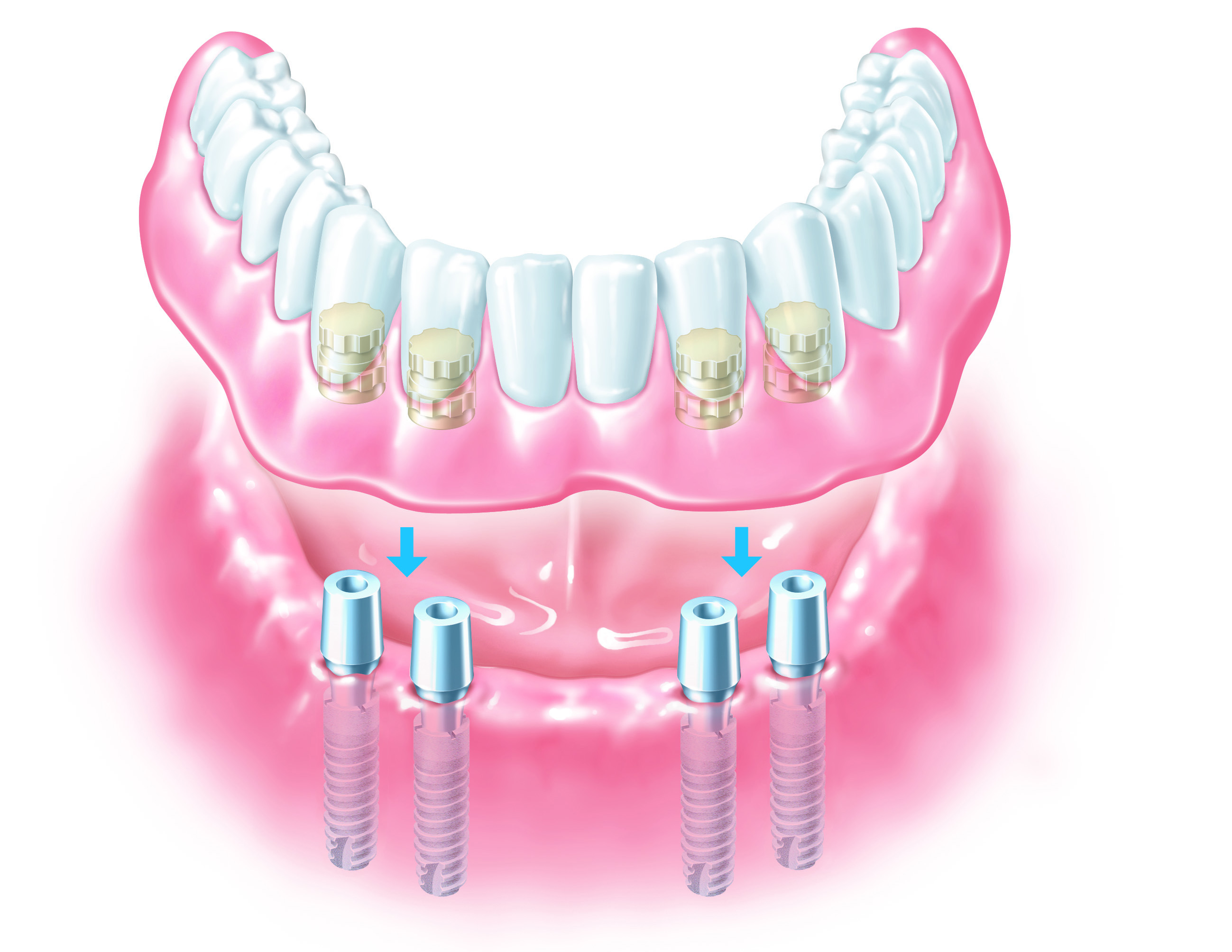 Cost of Full Mouth Dental Implants UK 2019