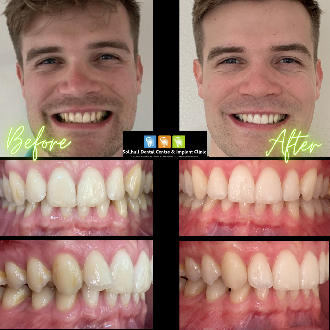 Invisalign Solihull and Birmingham