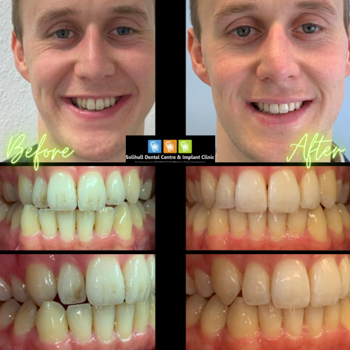 Invisalign Solihull and Birmingham Solihull Dental Centre & Implant