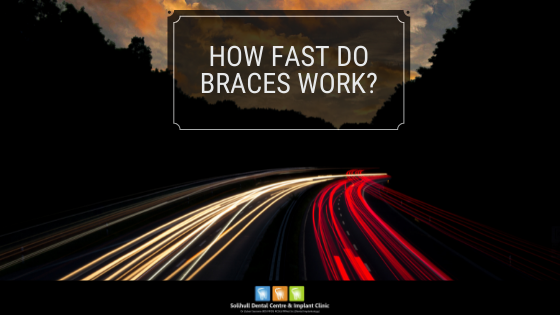 fast braces