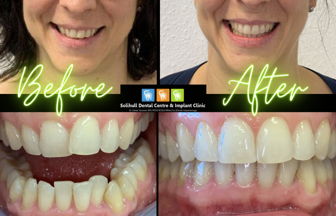 Invisalign treatment