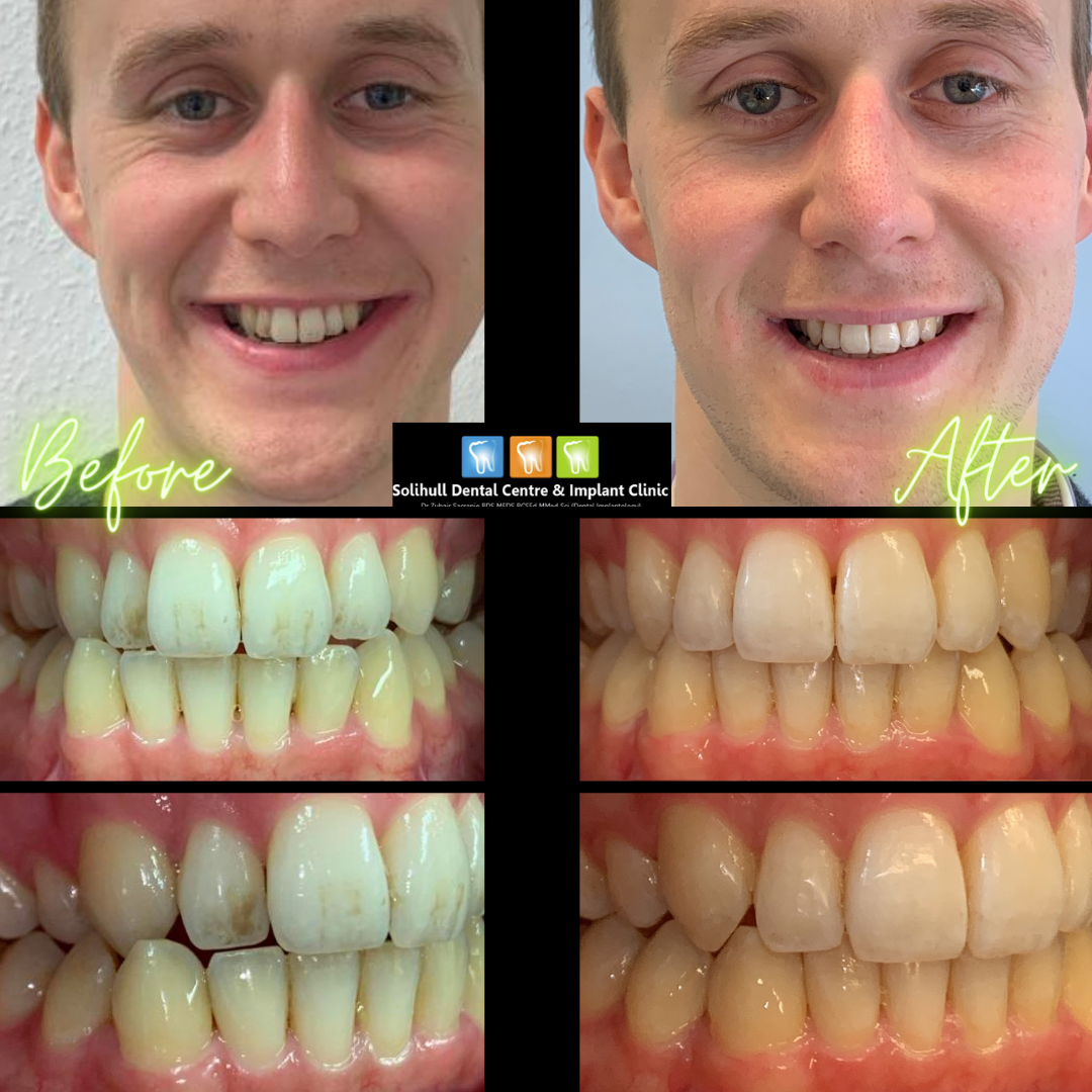 Invisalign photograph