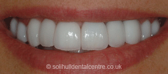 after cosmetic dentistry