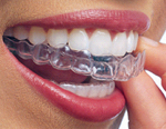 Invisalign