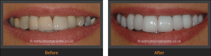 dental crowns before and after