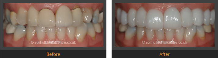 dental crowns before and after