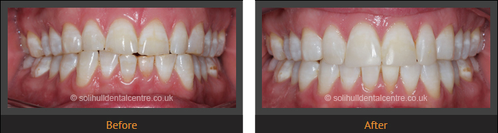 orthodontics before and after
