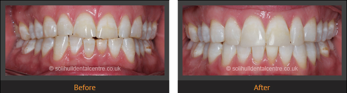 Before and after adult orthodontics