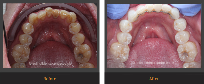 orthodontics before and after clues all view lower