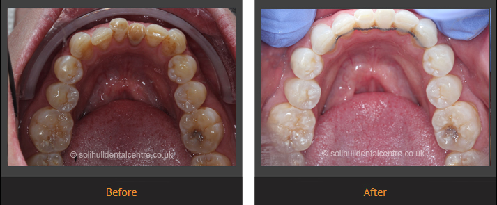 Before and after