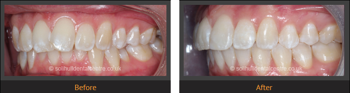 orthodontics before and after