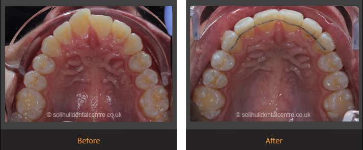 orthodontics before and after a review