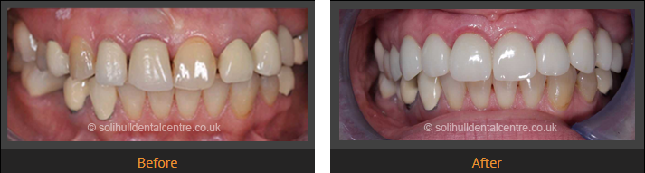 dental implants before and after