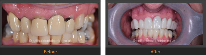 before and after dental implants