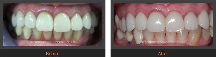 dental implants before and after